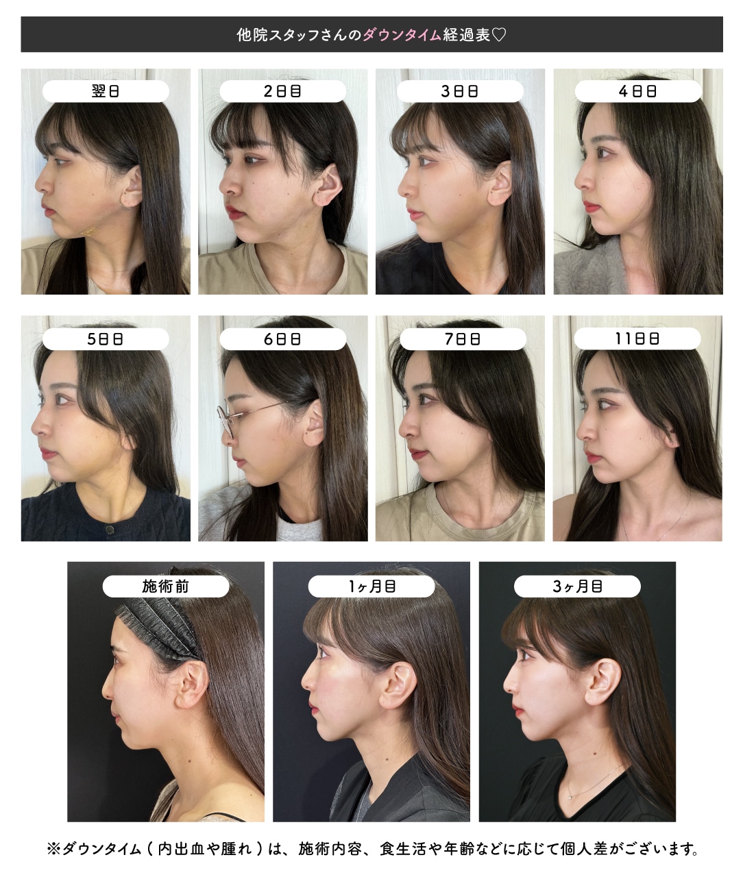 顔の脂肪吸引のダウンタイム実態！腫れ・内出血の経過と復帰目安