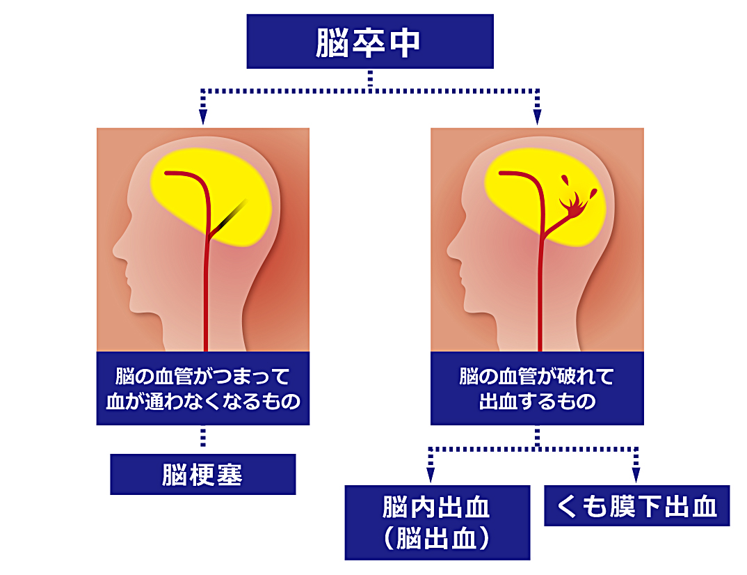 脳卒中と脳梗塞の決定的な違いとは？命を守る前兆サインと最新治療法