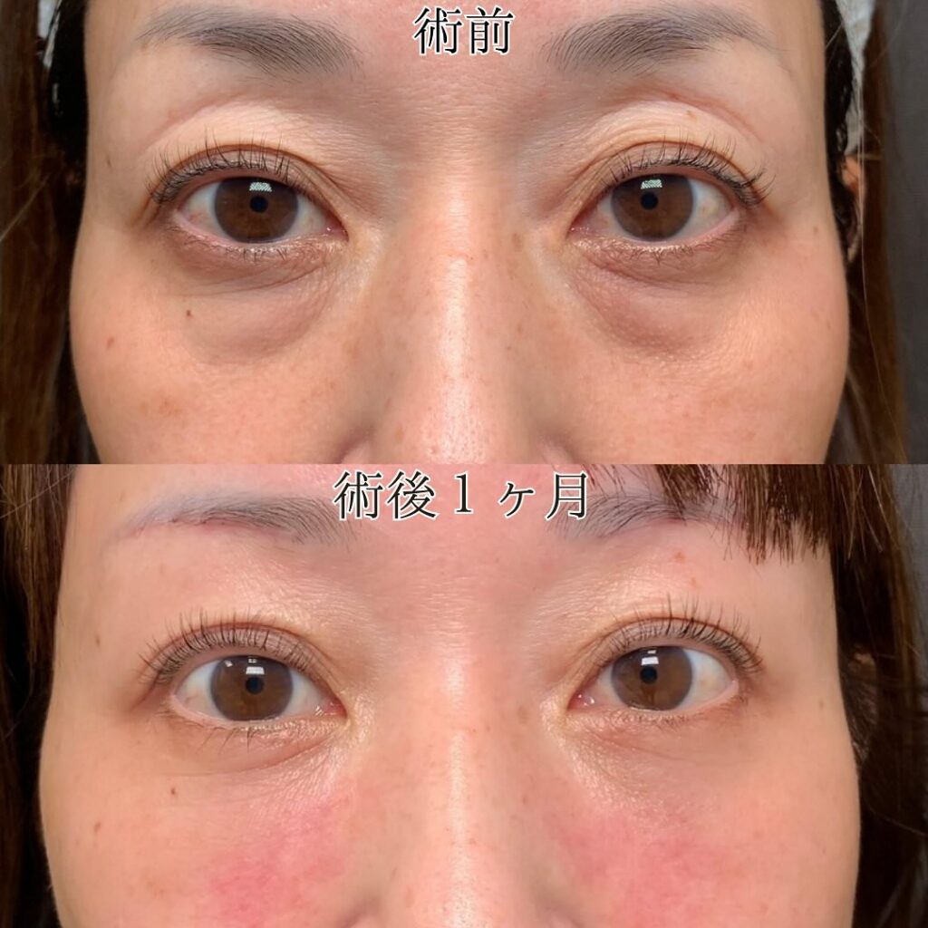 目の下のたるみ取りで後悔する人と成功者の差｜失敗理由と費用相場