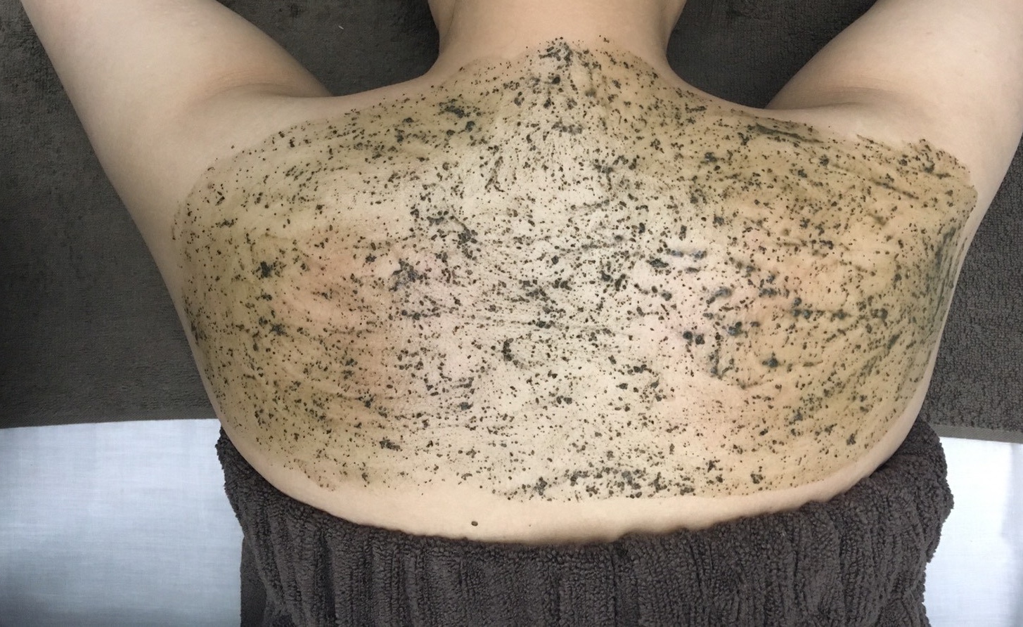 背中の角栓が取れない本当の理由とは？押し出しNgの真相と最新ケア法
