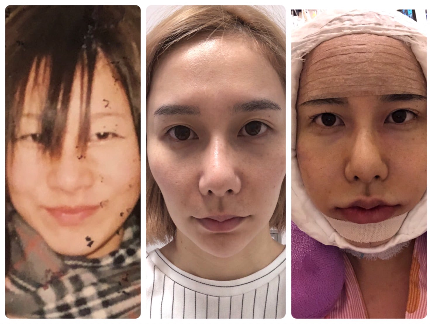 ありしゃん整形総額850万円の全貌！昔の顔と劇的ビフォーアフター