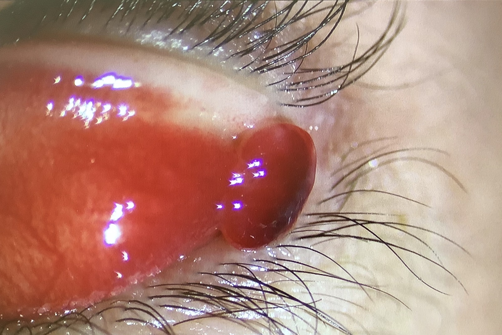 まぶたの裏にできものが！痛い・白い粒の正体と失敗しない治し方徹底解説