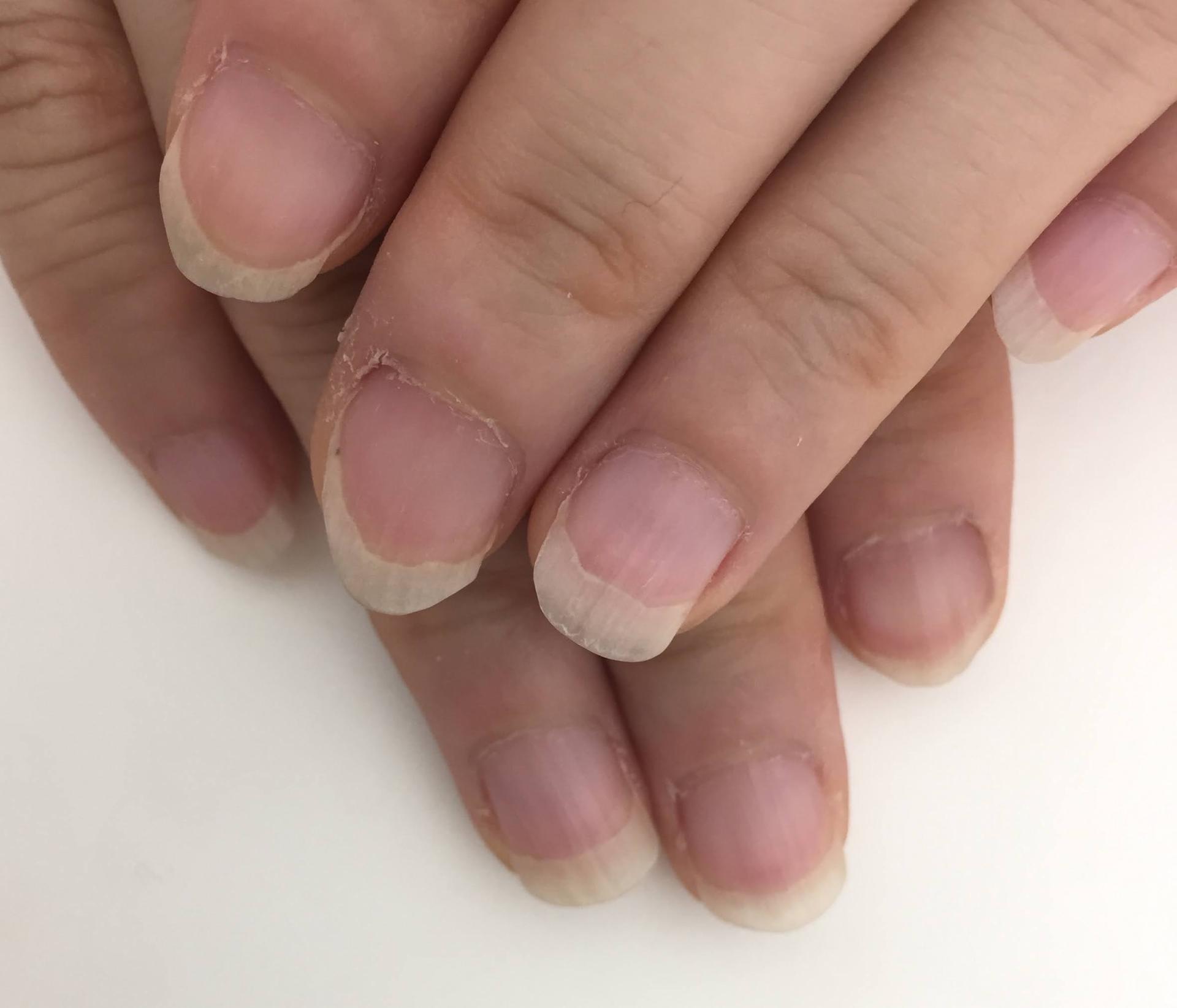 爪の白い部分が多い原因は病気の兆候？ピンクを伸ばす育爪ケア徹底解説