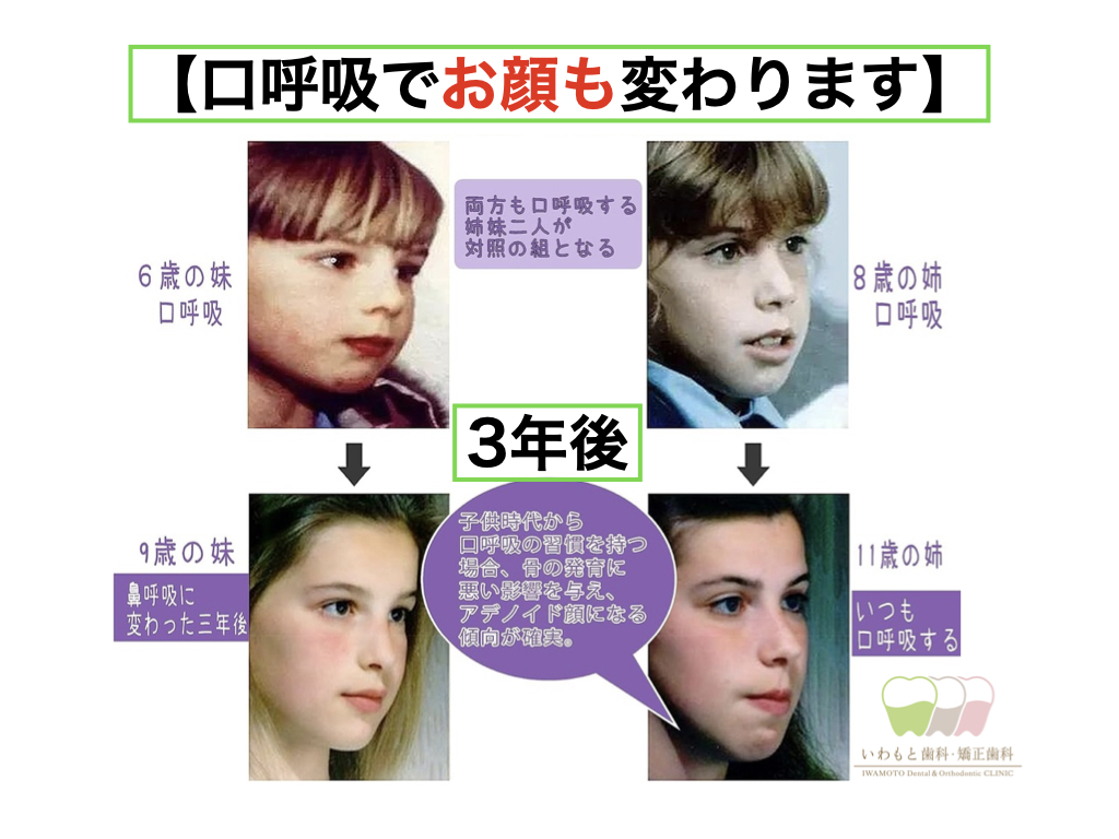 口呼吸から鼻呼吸に切り替えた結果！顔つきの激変と睡眠改善の真相