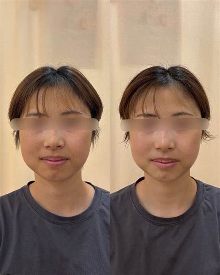 親知らず抜歯で小顔になる? ビフォーアフター写真から見る真実